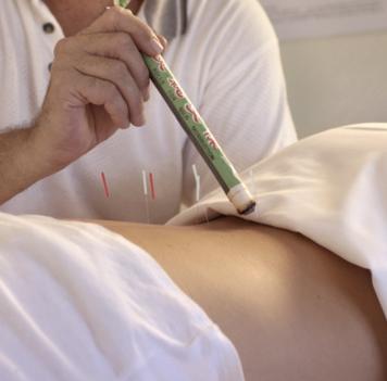 Schwangere setzen auf Akupunktur - verkürzt die Geburt und lindert Schmerzen 