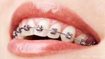 Pflege von Zahnspangen